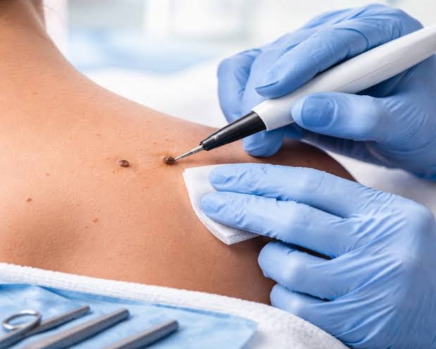 What determines the right approach to Skin Lesion Removal