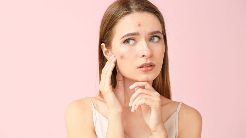Acne in Adults 2