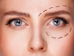 Chirurgie des paupieres superieures a Paris
